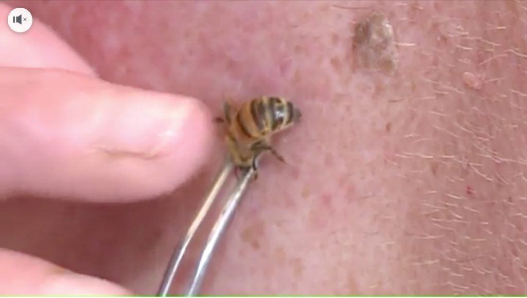 honeybee stinging man's back